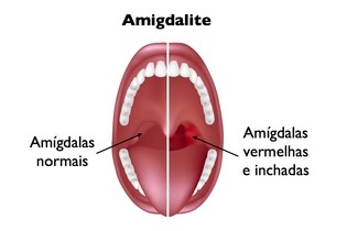 Amigdalite _ Amigdalite: tipos, sintomas, diagnóstico e tratamento ...